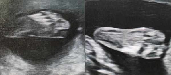 Bild zu Organultraschall - Forum für September - Mamis