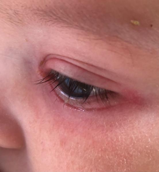 Bild zu Rotes Auge - ewig entzündet - Forum für September - Mamis