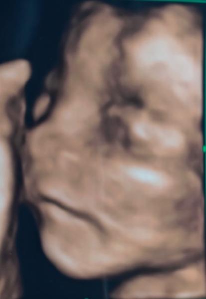 Bild zu Zurück von der Feindiagnostik - Forum für September - Mamis