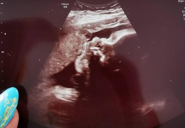 Bild zu 3.Screening und CTG - Forum für September - Mamis