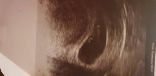 Bild zu Nach ersten thermin - Forum für September - Mamis