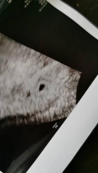 Bild zu Heute doch mal einen Ultraschall gemacht - Forum für September - Mamis
