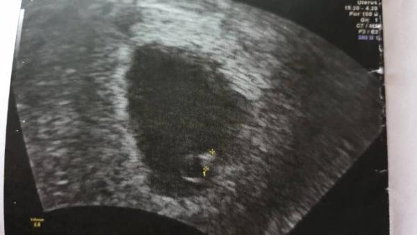Bild zu Erstes Ultraschallbild 🥰 - Forum für September - Mamis