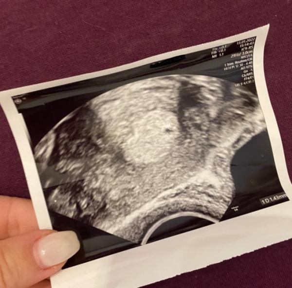 Bild zu Fruchthöhle zu klein? - Forum für September - Mamis