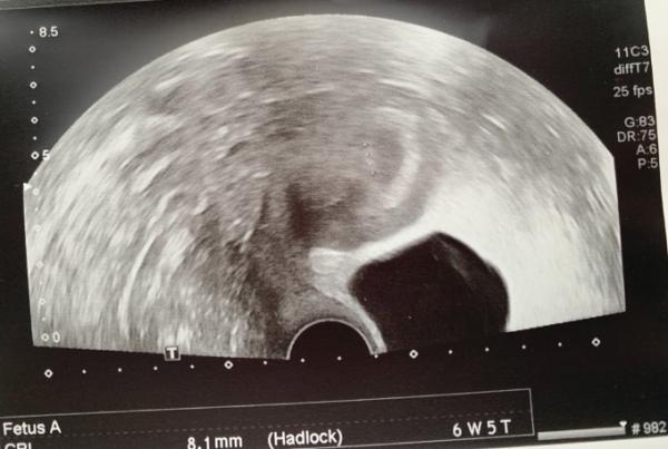 Bild zu Komisches Ultraschallbild đ€ - Forum fĂŒr September - Mamis