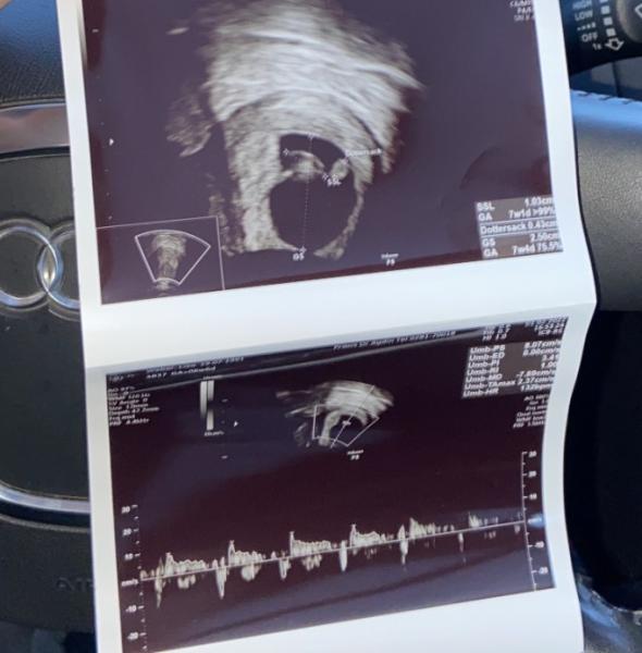 Bild zu Ultraschallbild - Forum für September - Mamis