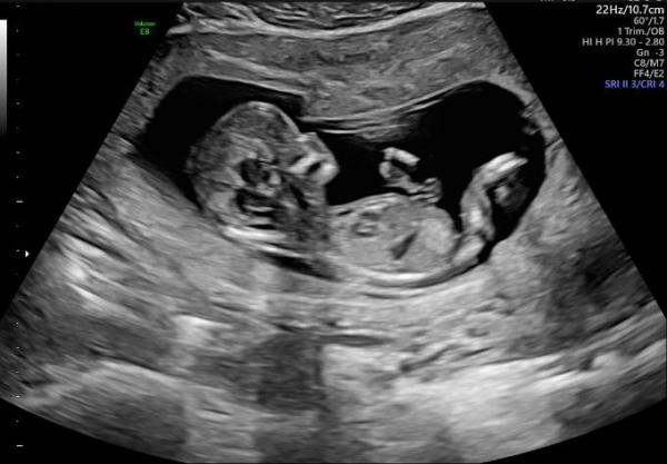 Bild zu Geschlecht zu erkennen? - Forum für September - Mamis