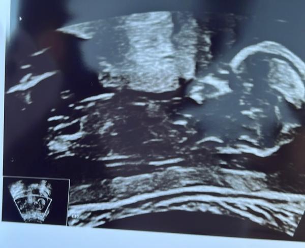 Bild zu Geschlechtserkennung 🥰 - Forum für September - Mamis