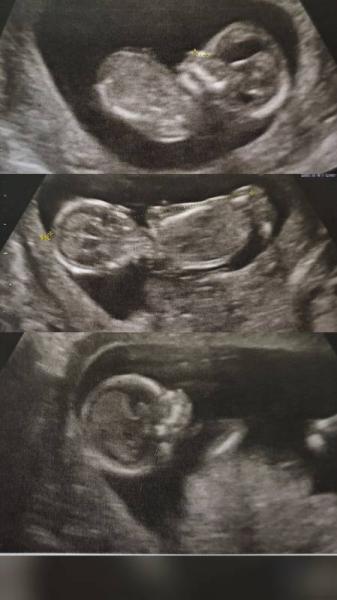 Bild zu Zurück vom Ultraschall - Forum für September - Mamis