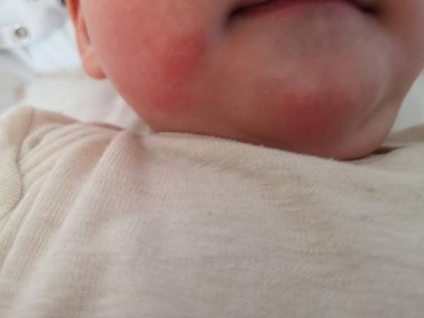 Bild zu Wunf geriebener Mundbereich - Forum für September - Mamis