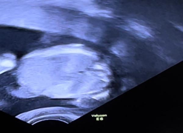 Bild zu Ultraschall Geschlecht 18.ssw - Forum für September - Mamis