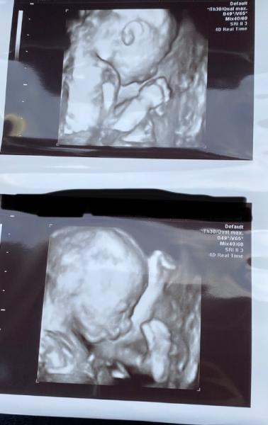 Bild zu Feindiagnostik 🥰 - Forum für September - Mamis