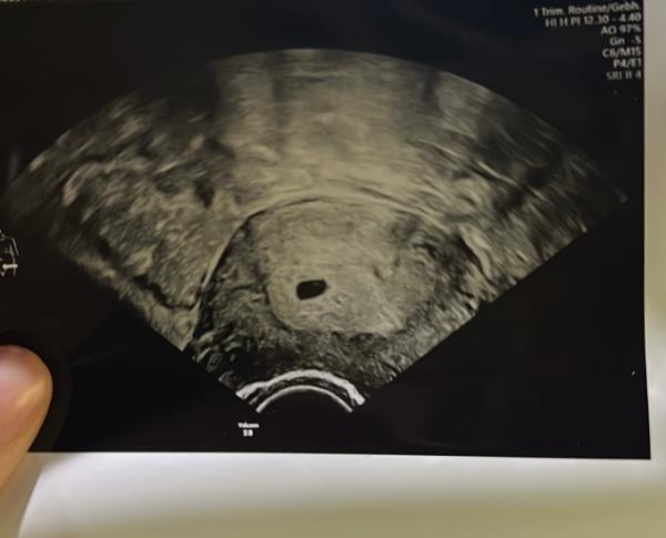 Bild zu Ultraschall 5+0 - Forum für September - Mamis