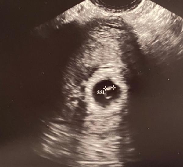 Bild zu Zurück vom Ultraschall - Forum für September - Mamis