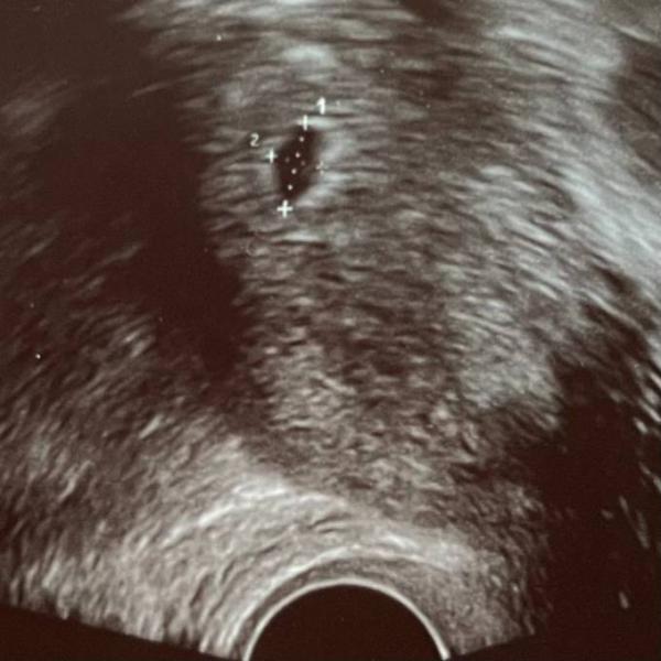 Bild zu 1. Schwangerschaft - Ultraschall 5+1 - Forum für September - Mamis