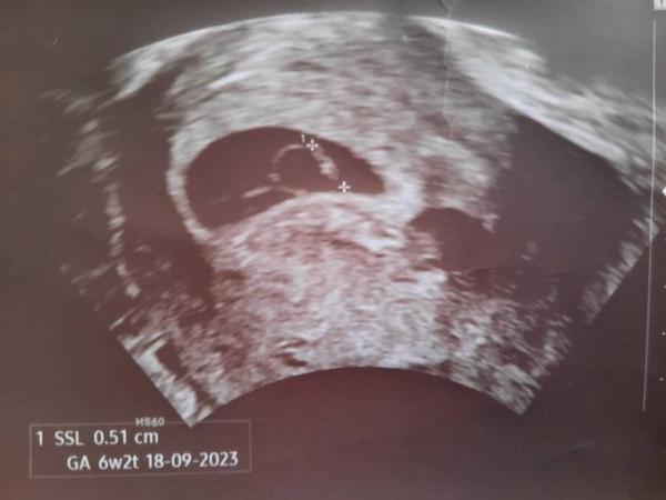 Bild zu Embryo zu klein, sieht jemand auch ne 2. Fruchthöhle - Forum für September - Mamis