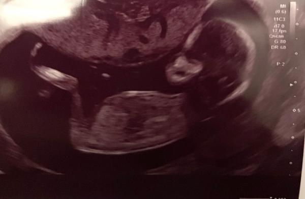 Bild zu Schockverliebt :-) Ultraschall 14. SSW - Forum für September - Mamis