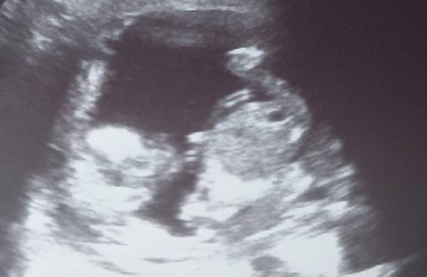 Bild zu Kann man sein Baby zerdrücken? - Forum für September - Mamis