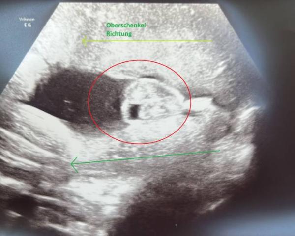 Bild zu Pure Verwirrung ... Geschlecht des Babys  wechselt von Termin zu Termin??! - Forum für September - Mamis