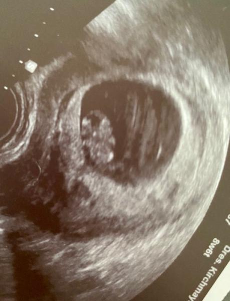 Bild zu Heute Ultraschall - Forum für September - Mamis