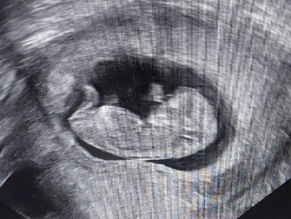 Bild zu Zweiter Ultraschall - Forum für September - Mamis