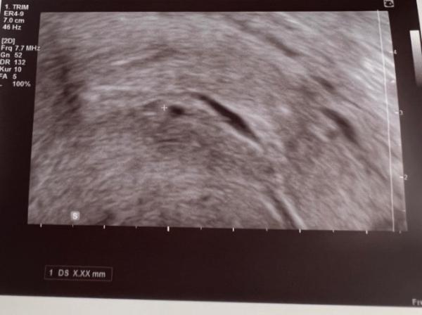 Bild zu Ärztin hat keinerlei Hoffnung hcg zu niedrig - Forum für September - Mamis
