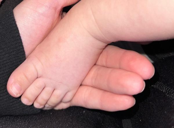 Bild zu Zehnägel in der Mitte durchgebrochen, 6 Monate alt - Forum für September - Mamis