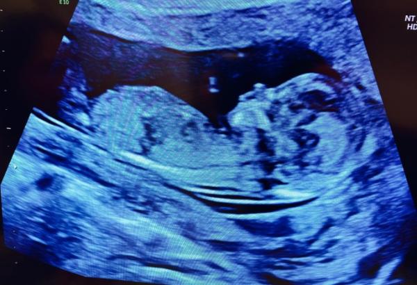 Bild zu Heute Ersttrimesterscreening und NIPT - Forum für September - Mamis
