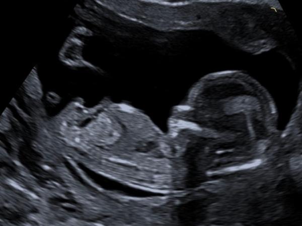 Bild zu Ultraschallexperten - welches Geschlecht - Forum für September - Mamis