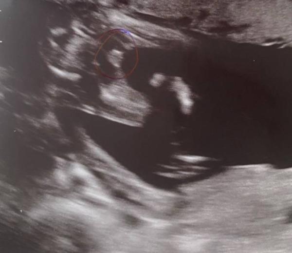 Bild zu Ultraschall Bild - Mädchen oder Junge? - Forum für September - Mamis