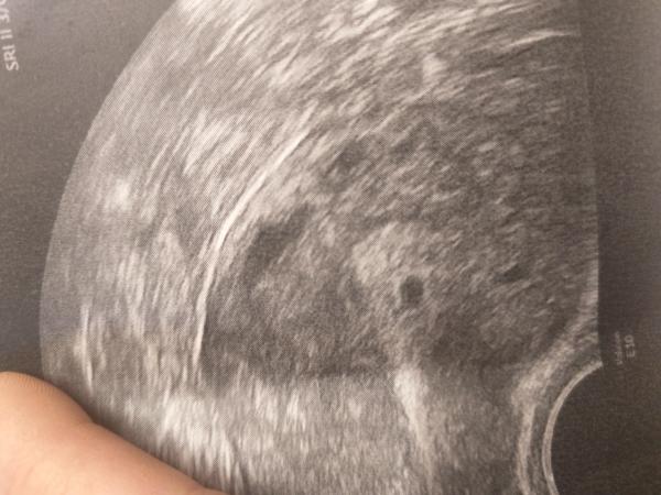Bild zu 5+3 nur fruchthöhle - Forum für September - Mamis
