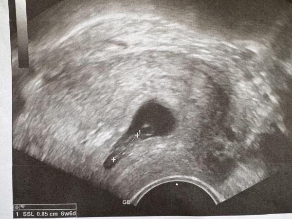 Bild zu Zurück vom 1. Ultraschall - Forum für September - Mamis