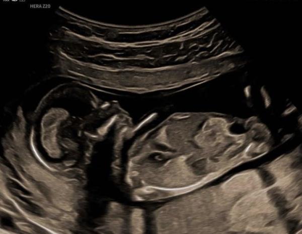 Bild zu Junge oder Mädchen was meint ihr? 💙🩷 - Forum für September - Mamis