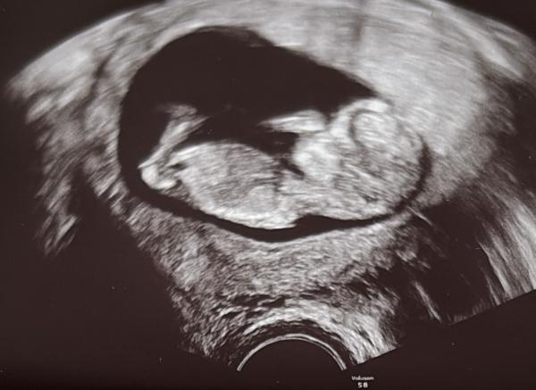 Bild zu Mädchen oder Junge? 🩵🩷 - Forum für September - Mamis