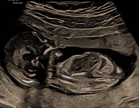 Bild zu Junge oder Mädchen was meint ihr? 💙🩷 - Forum für September - Mamis