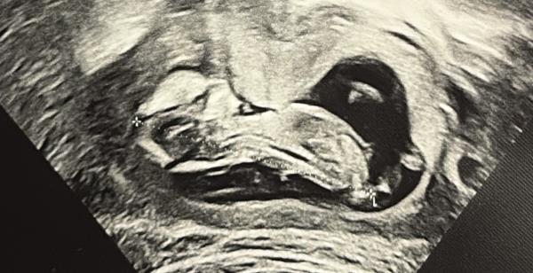 Bild zu Mädchen oder Junge? 🩵🩷 - Forum für September - Mamis