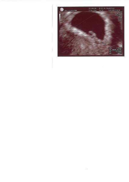Bild zu SSW 6+3 - Forum für Oktober - Mamis