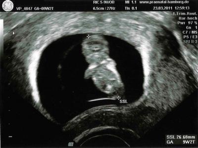 Bild zu US Bilder VU 9+2 - Forum für Oktober - Mamis