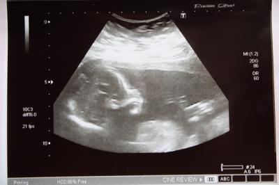 Bild zu Ich hatte heut auch Feindiagnostik! - Forum für Oktober - Mamis