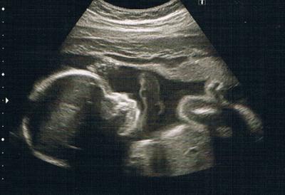 Bild zu VU, zum Glück US machen lassen & Kreißsaalbesichtigung - Forum für Oktober - Mamis