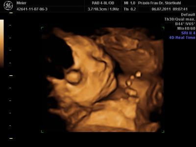 Bild zu Zurück vom Zuckertest, VU und 3D-US - Forum für Oktober - Mamis