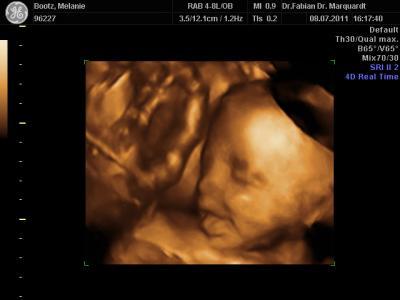 Bild zu Live 3 D Ultraschall - Forum für Oktober - Mamis