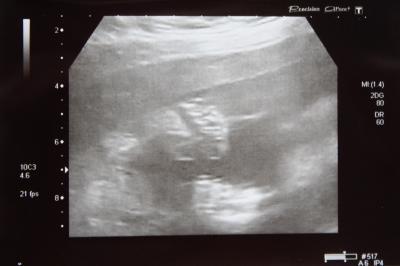 Bild zu hatte vu und organscreening - Forum für Oktober - Mamis
