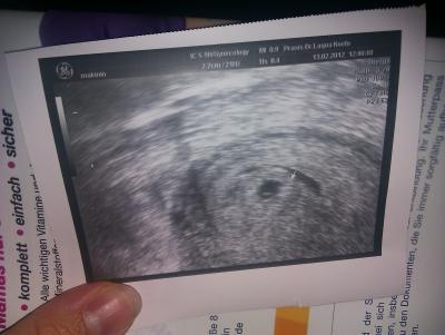 Bild zu zurück vom fa... utrogest,bluterguss +bild - Forum für Oktober - Mamis