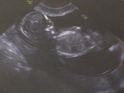 Bild zu US-Termin mit einem lachenden und einem weinenden Auge - Forum für Oktober - Mamis