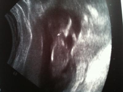 Bild zu So wieder da - puuuh alles gut !! - Forum für Oktober - Mamis