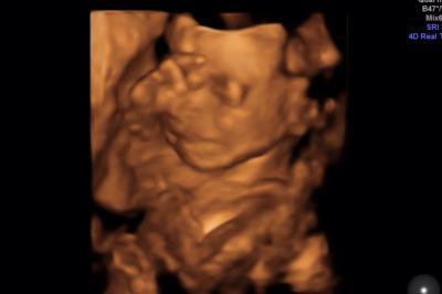 Bild zu Gestern Organscreening + 3D-Bild - Forum für Oktober - Mamis