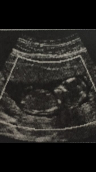 Bild zu Was meint ihr welches Geschlecht es sein könnte? - Forum für Oktober - Mamis