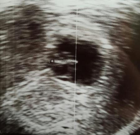 Bild zu Ultraschallbild? - Forum für Oktober - Mamis