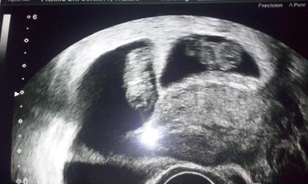 Bild zu Lieben Dank für die vielen Daumen... - Forum für Oktober - Mamis